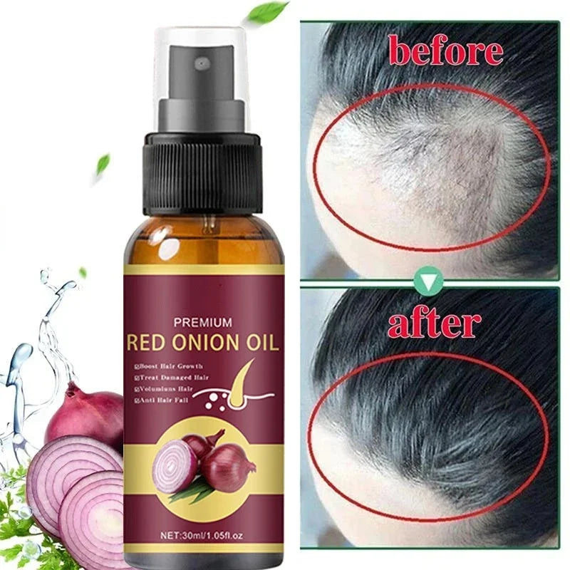 Sérum anti-calvitie à base d'ognon pour la pousse des cheveux